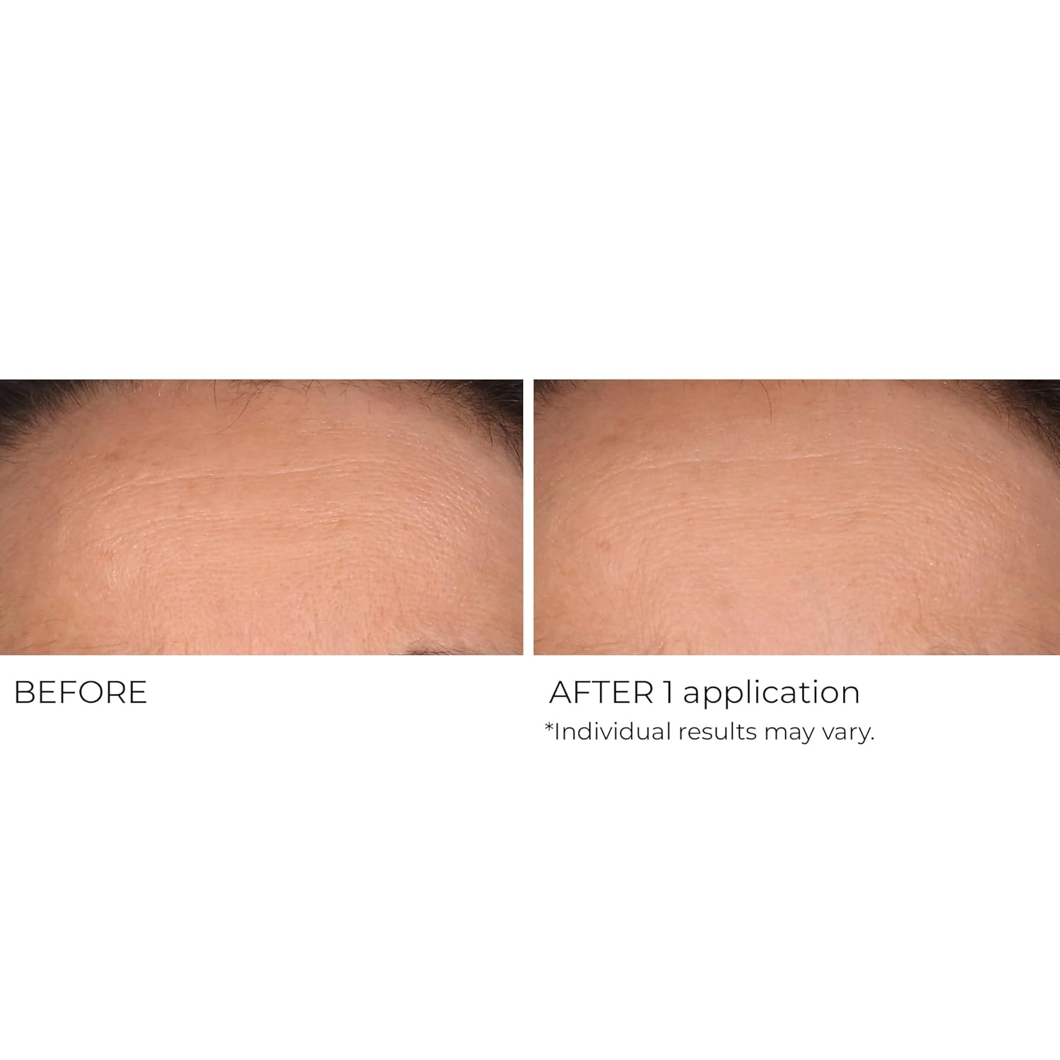 image:imageNassifMD Wrinkle Blur Targeted Treatment