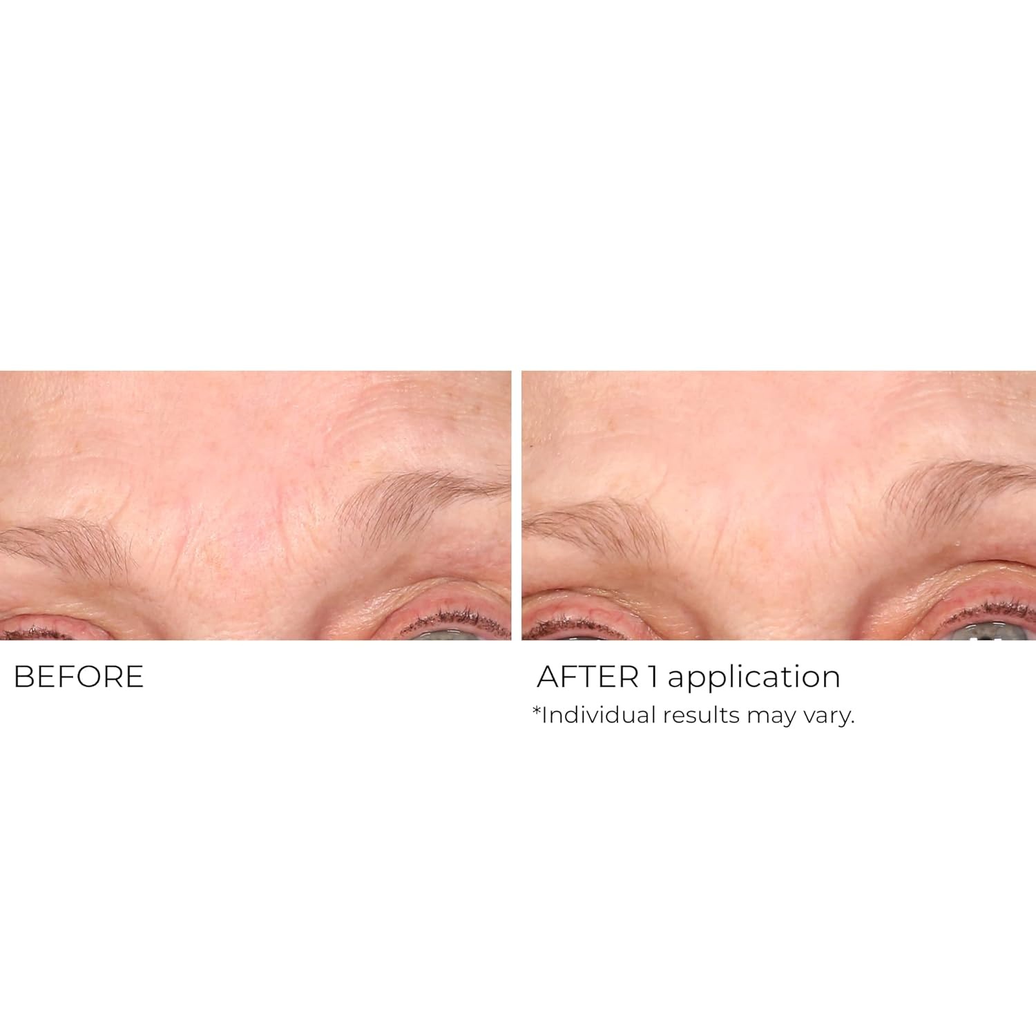 image:imageNassifMD Wrinkle Blur Targeted Treatment