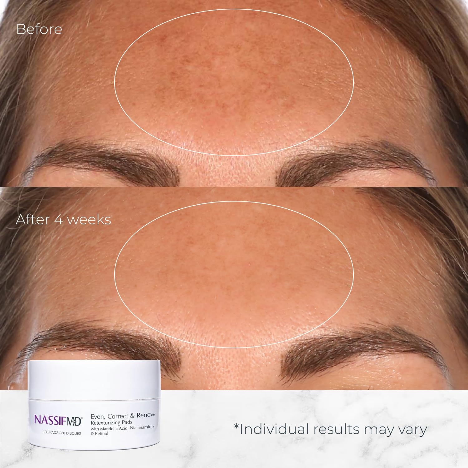 image:imageNassifMD Even Correct amp Renew Retexturizing Pads Chemical Peel for Face Whitehead Closed Comedone and Acne Marks Skin Resurfacing Pads Hyperpigmentation Treatment for Face30 Pads
