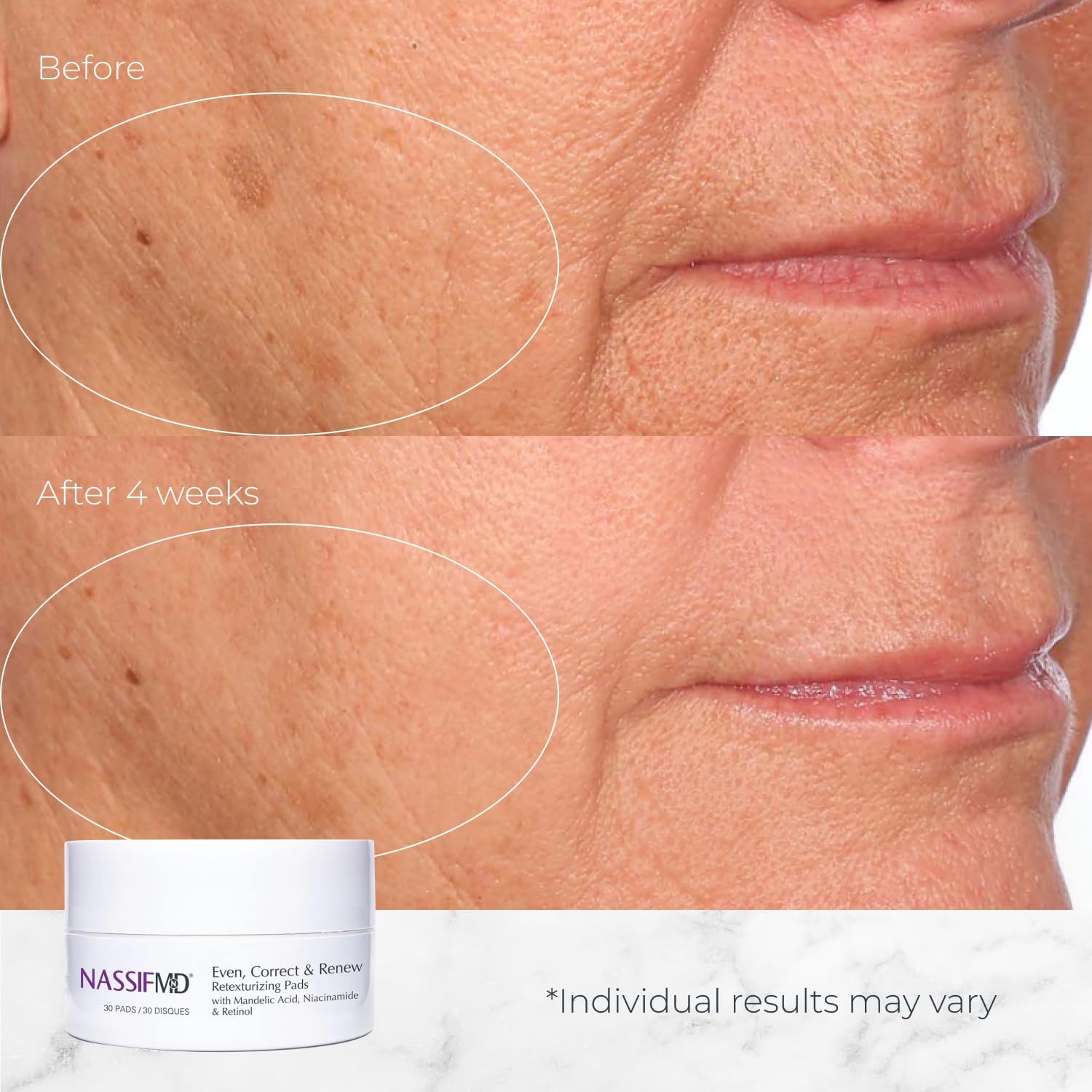 image:imageNassifMD Even Correct amp Renew Retexturizing Pads Chemical Peel for Face Whitehead Closed Comedone and Acne Marks Skin Resurfacing Pads Hyperpigmentation Treatment for Face30 Pads