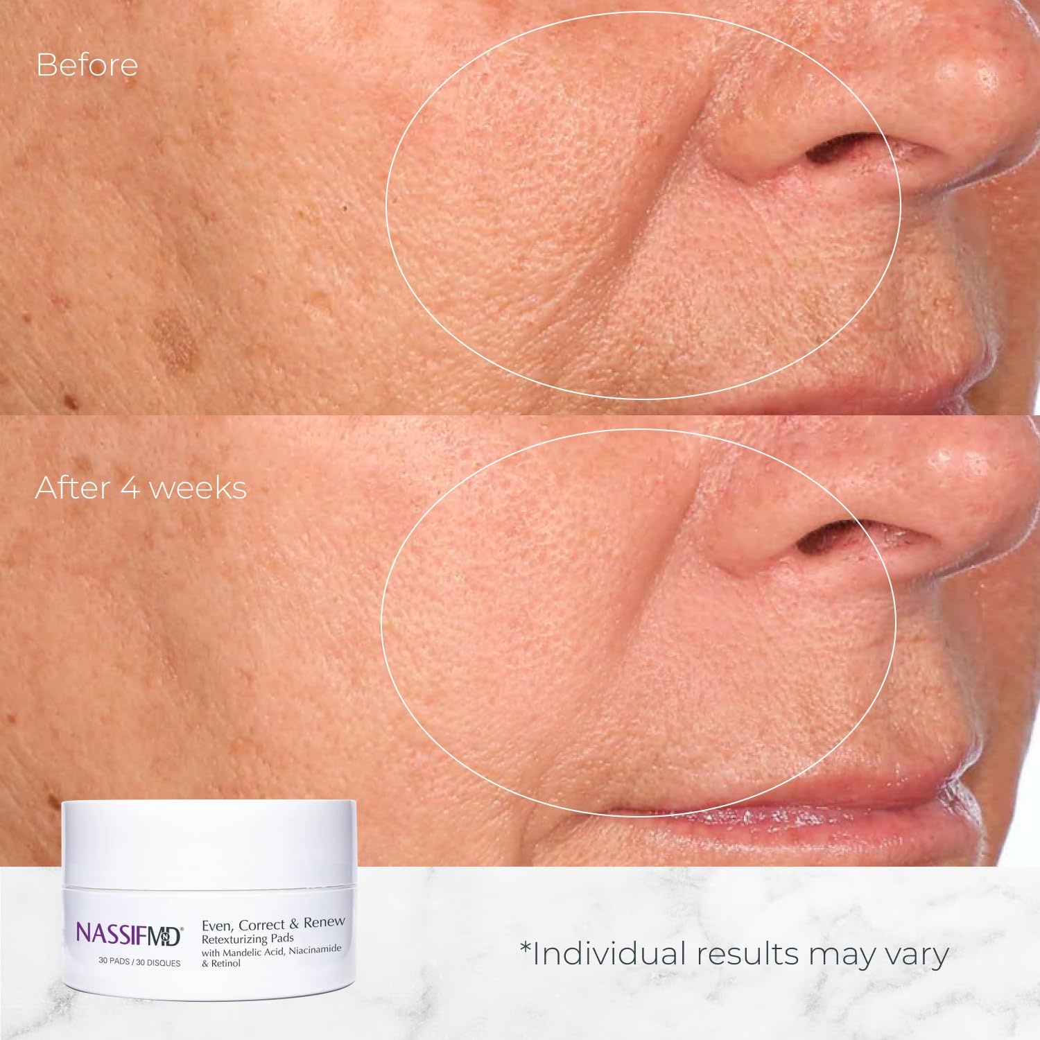 image:imageNassifMD Even Correct amp Renew Retexturizing Pads Chemical Peel for Face Whitehead Closed Comedone and Acne Marks Skin Resurfacing Pads Hyperpigmentation Treatment for Face30 Pads